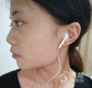 找上海美联臣李相雨做下颌角手术，大家看看做的怎么样?