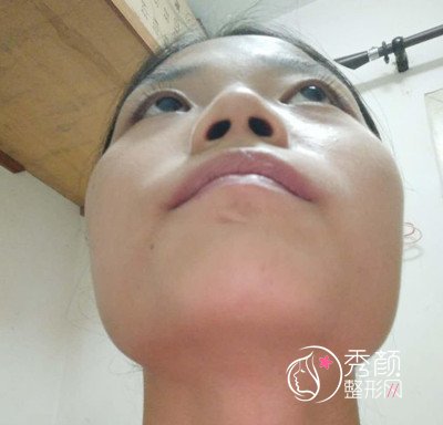 找上海美联臣李相雨做下颌角手术，大家看看做的怎么样?