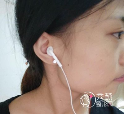 找上海美联臣李相雨做下颌角手术，大家看看做的怎么样?