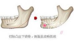 下颌角磨骨截骨手术到底要不要留角?