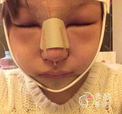 上海美联臣假体隆鼻和垫下巴及下颌角整形案例全过程分享。