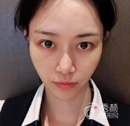 做的隆鼻是我奢望的那种鼻子，我也终于有叻。