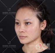 在北京何照华那儿做了颧骨颧弓+下颌角磨骨手术和大家分享。