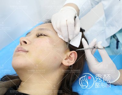 在北京何照华那儿做了颧骨颧弓+下颌角磨骨手术和大家分享。