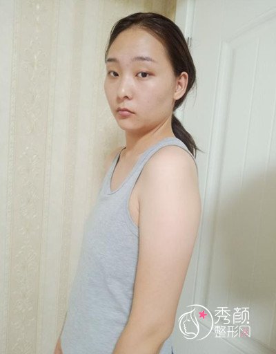 在北京上上相做的自体脂肪隆胸,看看我做的怎么样。