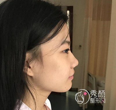 上海伯思立周珍艳做的隆鼻和双眼皮,美到想不到。