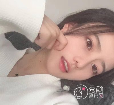 上海伯思立周珍艳做的隆鼻和双眼皮,美到想不到。