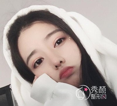 上海伯思立周珍艳做的隆鼻和双眼皮,美到想不到。