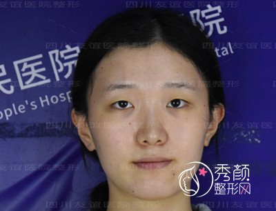 四川省友谊整形医院李萍割双眼皮术后一周恢复案例。
