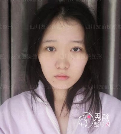 四川省友谊整形医院李萍割双眼皮术后一周恢复案例。