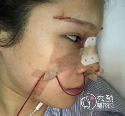 上海伊莱美钱玉鑫肋软骨隆鼻修复案例。