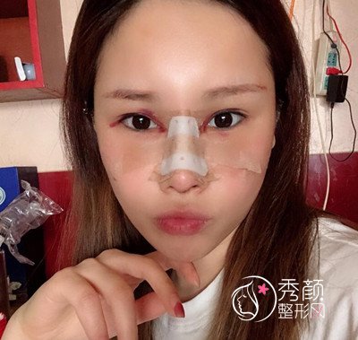 上海伊莱美钱玉鑫肋软骨隆鼻修复案例。