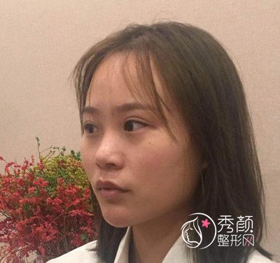 成都玉之光黄开亮隆鼻+自体脂肪填充案例