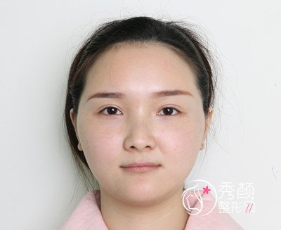 北京艺美王东脂肪填充失败修复案例。