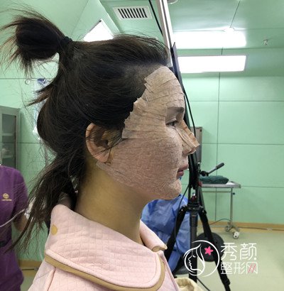 北京艺美王东脂肪填充失败修复案例。