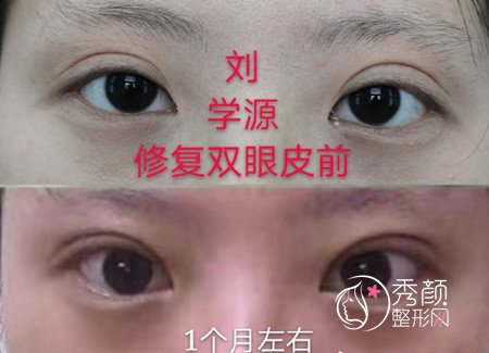 青岛刘学源双眼皮修复怎么样?价格 案例。