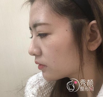 上海李保锴鼻修复案例