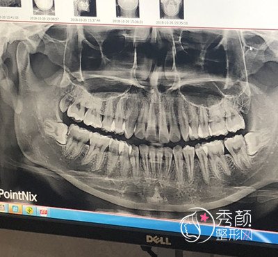 我在上海首尔丽格做的颧骨颧弓 下颚线切除