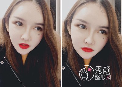 我在上海首尔丽格做的颧骨颧弓 下颚线切除