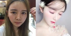 <b>上海百达丽韩嘉毅和伊莱美钱玉鑫哪个隆鼻好、对比。</b>