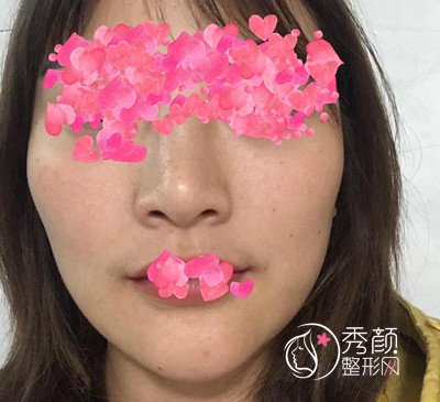 上海首尔丽格颧骨内推怎么样,看崔荣达给我做的脸型。