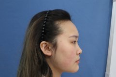 杭州格莱美医疗美容医院汪云锋医生鼻部多项