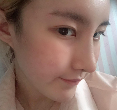 青岛华颜美孙好杰鼻部手术隆鼻术后5个月案例。
