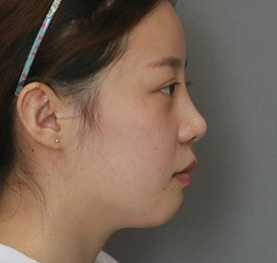 北京米扬丽格巫文云膨体+鼻中隔鼻修复案例。