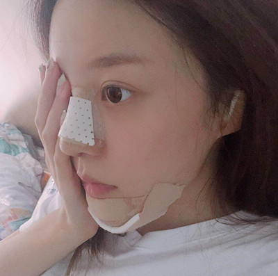 北京米扬丽格巫文云膨体+鼻中隔鼻修复案例。