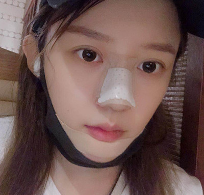 北京米扬丽格巫文云膨体+鼻中隔鼻修复案例。