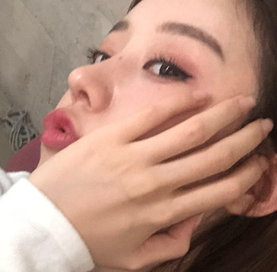 北京米扬丽格巫文云膨体+鼻中隔鼻修复案例。