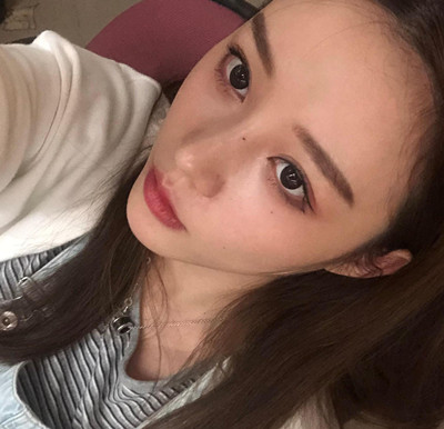 北京米扬丽格巫文云膨体+鼻中隔鼻修复案例。