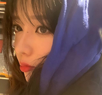 北京米扬丽格巫文云膨体+鼻中隔鼻修复案例。