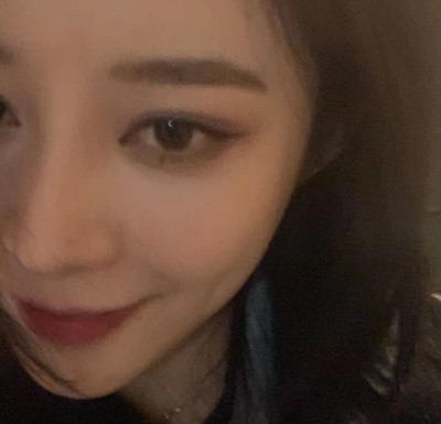 北京米扬丽格巫文云膨体+鼻中隔鼻修复案例。