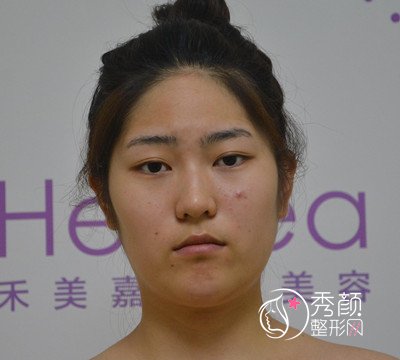 北京禾美嘉任学会面部填充+吸脂案例。