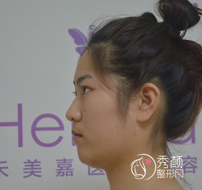 北京禾美嘉任学会面部填充+吸脂案例。