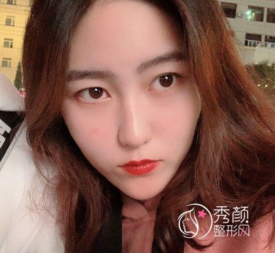 北京禾美嘉任学会面部填充+吸脂案例。