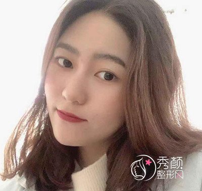 北京禾美嘉任学会面部填充+吸脂案例。