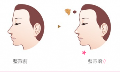 北京自体脂肪填充医院哪个医院好,东方和谐、八大处、禾美嘉等。