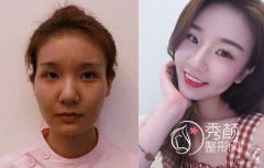 上海做自体脂肪填充哪个医院好？九院、伯思立、华美等。