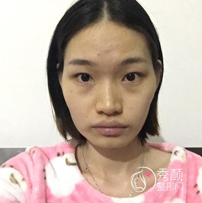 友谊整形李继华下颌角怎么样,李继华磨骨案例。