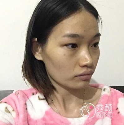 友谊整形李继华下颌角怎么样,李继华磨骨案例。