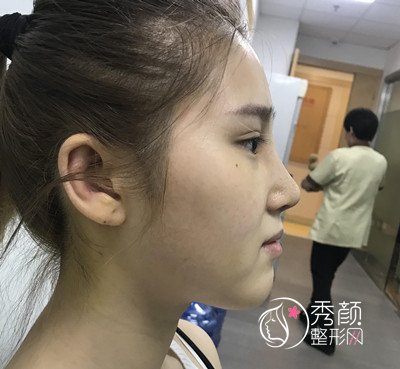 花了5万多上海华美徐文龙做的膨体隆鼻怎么样?