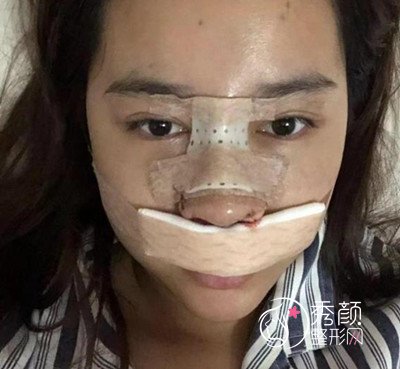南京华美曹海峰做的鼻部手术怎么样