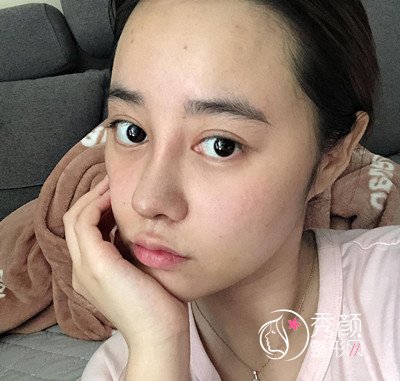 南京华美曹海峰做的鼻部手术怎么样