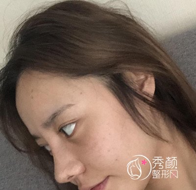 南京华美曹海峰做的鼻部手术怎么样