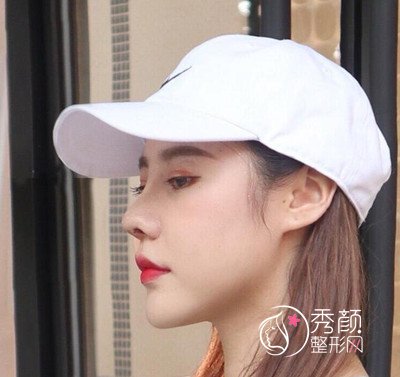 南京华美曹海峰做的鼻部手术怎么样