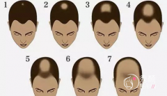 植发靠谱吗,植发大概需要多少钱,是长期的吗?