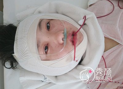 首尔丽格崔荣达Vline瓜子脸手术做的怎么样