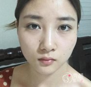 <b>上海磨骨哪个医生好,美联臣李相雨磨骨案例。</b>